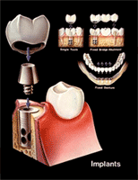 Implant